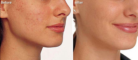Mesoestetic-Before-After1